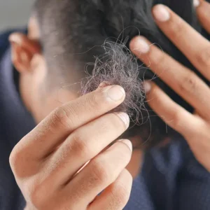 Alopecia - Causes of Alopecia