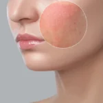 Allergies on the face - how it manifests itself, what are the causes of rashes